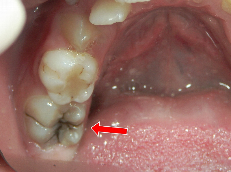 6歳臼歯（第一大臼歯）の虫歯