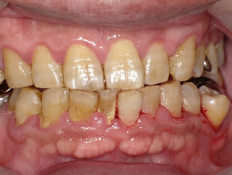 歯周病≒歯槽膿漏