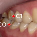虫歯C1は削って詰めるか再石灰化し自力で治す？