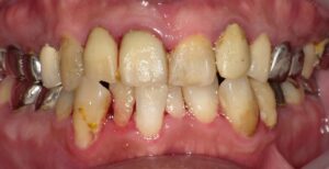 歯槽膿漏・歯周病・歯肉炎の違い