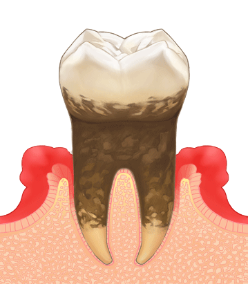 歯肉縁下歯石（黒い歯石）除去