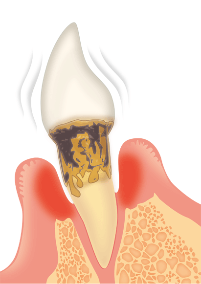 重度歯周病の縁下歯石 (黒い歯石)