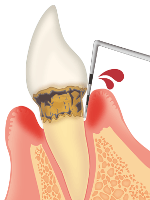 歯周病は慢性疾患