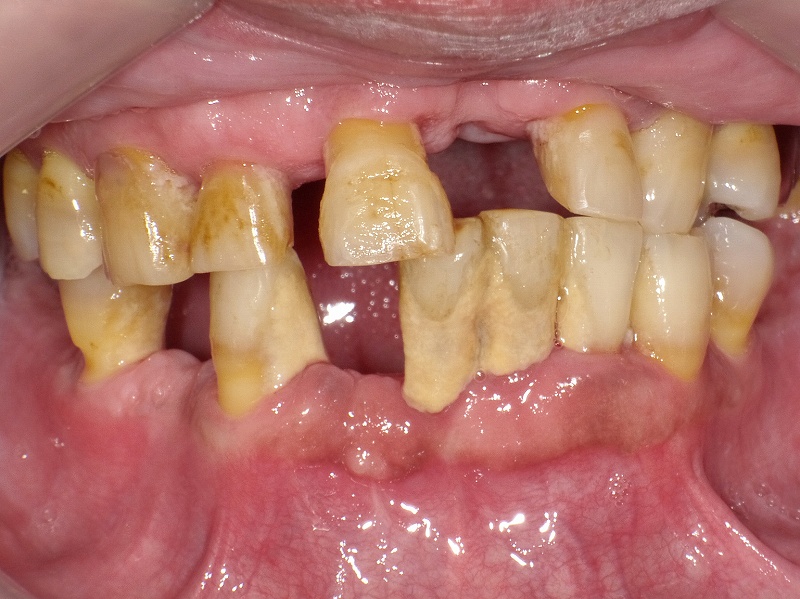 下顎前歯の複数歯に白い歯石が大量に付着