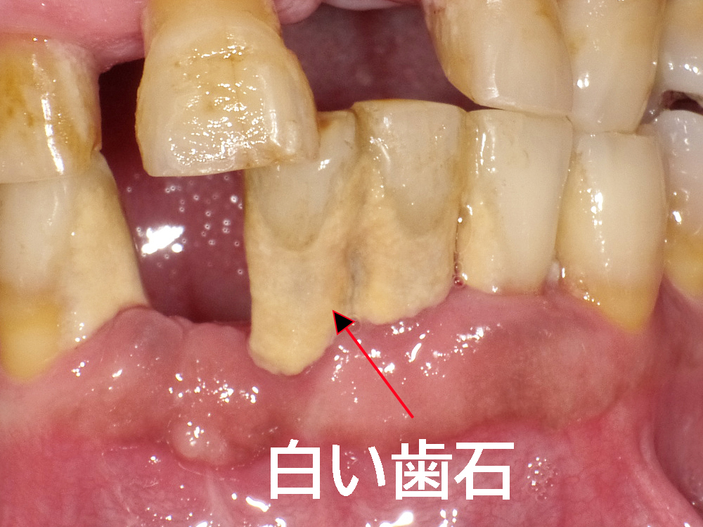 白い歯石