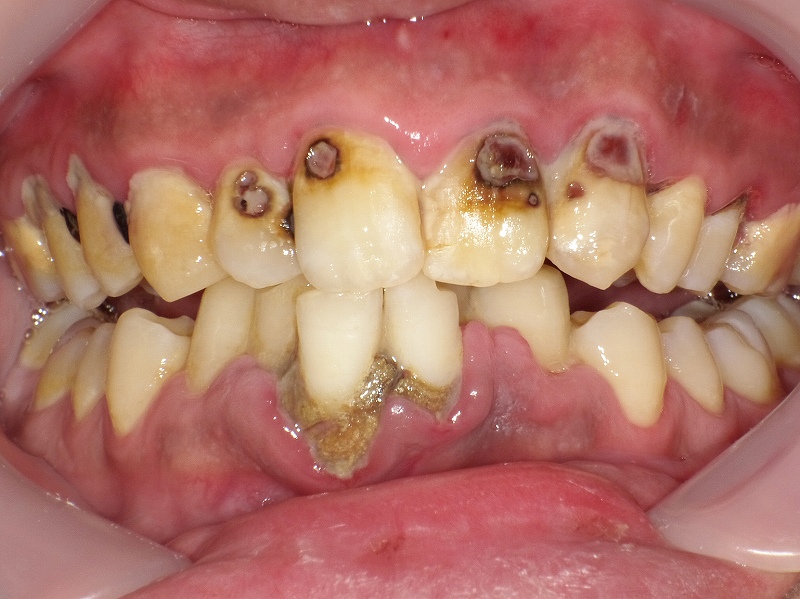 下顎前歯の２本に大量の黒い歯石