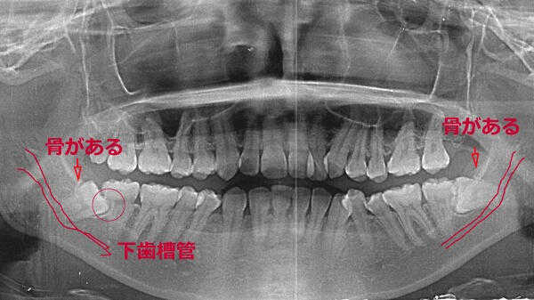 下顎の親知らずによる智歯周囲炎