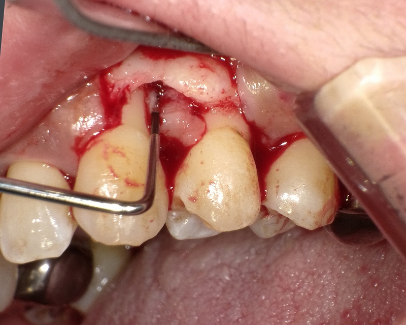 フラップ手術-歯肉剥離