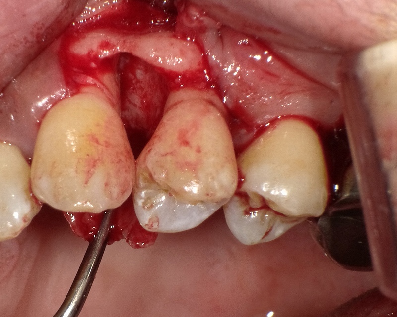 不良肉芽組織除去と歯根面滑沢化