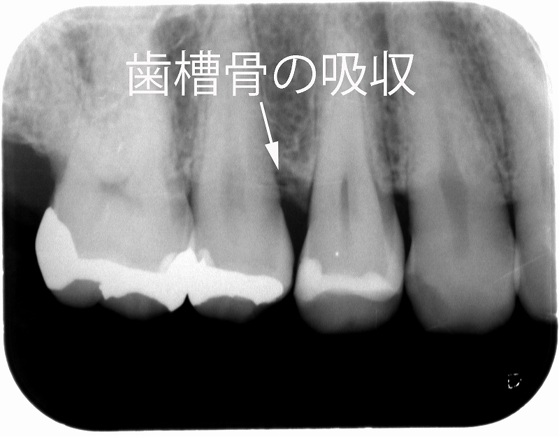 同症例の歯肉増殖部位のレントゲン写真