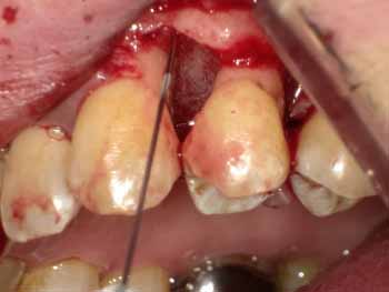 歯周外科や歯槽骨の再生治療の後