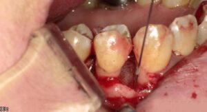 歯茎再生治療のリグロス