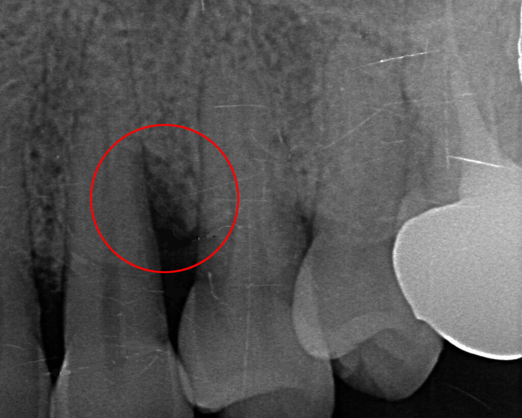 犬歯歯周ポケットのデンタルエックス線