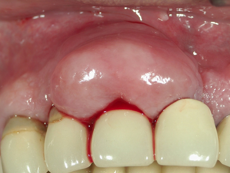 歯茎からの自然出血と顕著な腫脹