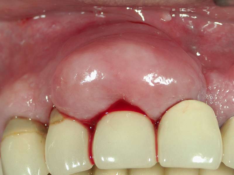 歯茎の腫れと歯茎からの出血