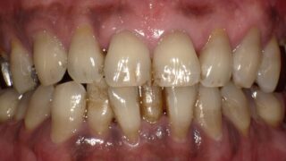 タバコが歯周病を悪化させる理由とは？歯茎が黒くなるメカニズムも解説