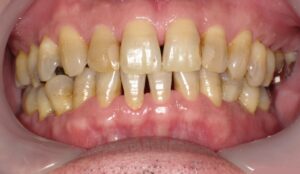 下がった歯茎をマッサージや歯磨き粉で自力で戻す方法？