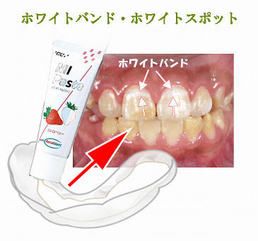 MIペーストで集中的な再石灰化ケア