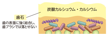 歯垢が石灰化して歯石になる