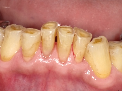 歯ぎしり・くいしばりが原因の歯周病