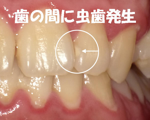 前歯の歯の間に虫歯発生