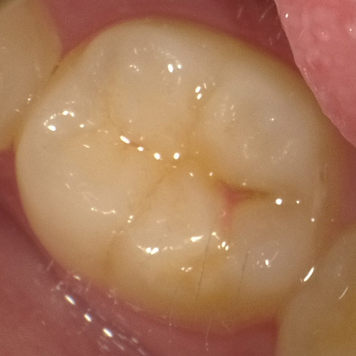 子供の6歳臼歯の溝が茶色に変色した初期虫歯CO
