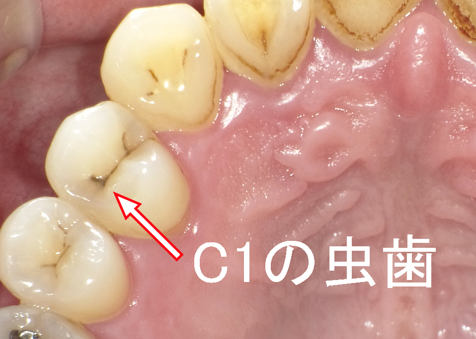第一小臼歯の溝にできた虫歯C1
