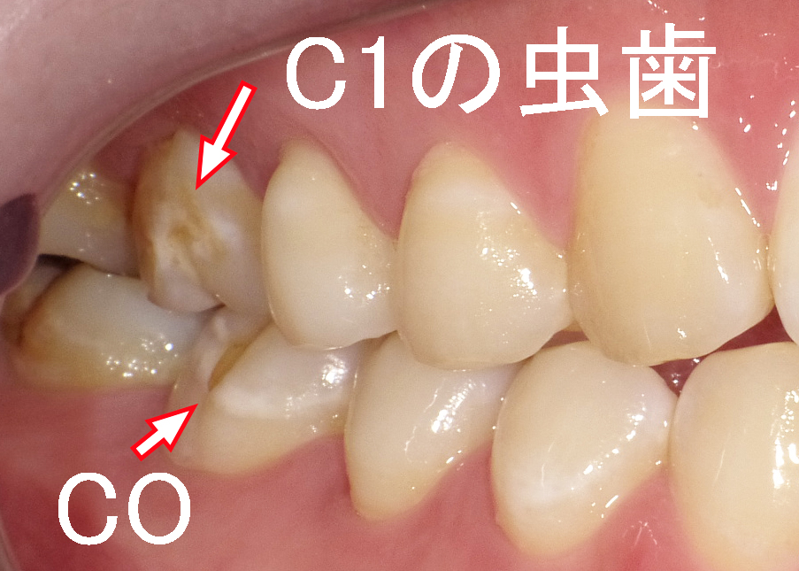 第1大臼歯の表側にできた虫歯C1