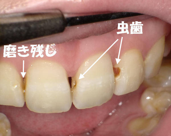前歯の歯間に虫歯