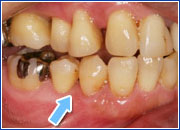 歯周基本治療終了時の口腔内写真