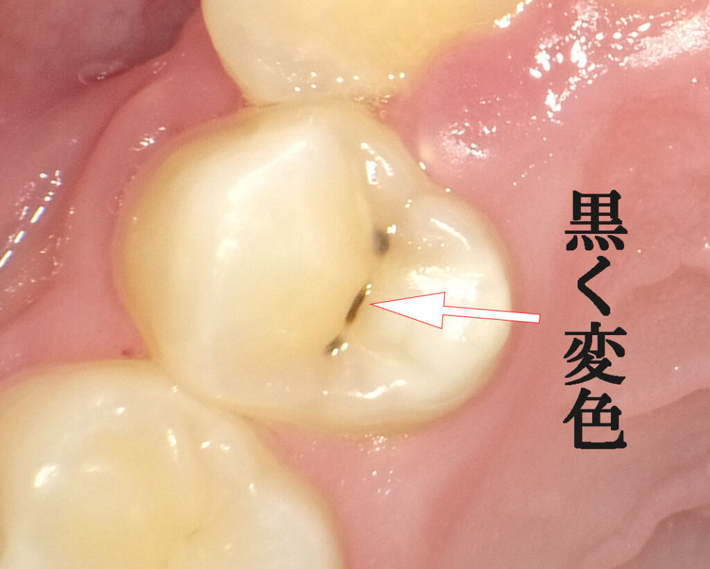 歯の溝に黒い点