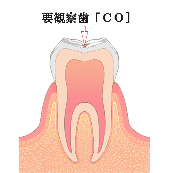 初期虫歯「CO」（要観察歯）の模式図