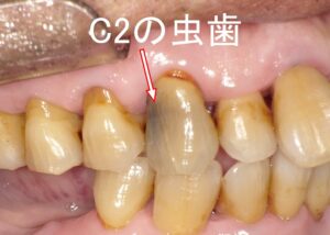 虫歯C2の見た目と治療法