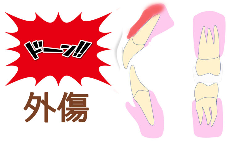 外傷による歯のグラつき