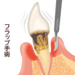 【フラップ手術】歯肉剥離掻爬術