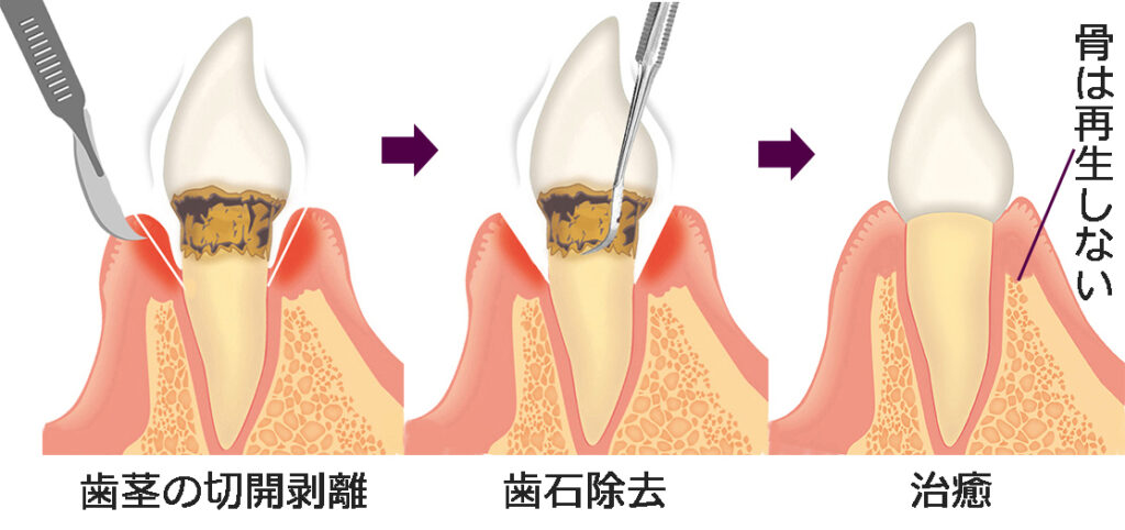 フラップ手術(歯肉剥離掻爬術)