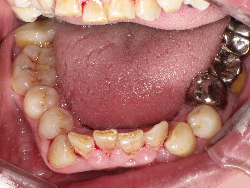 重度歯周病で下顎前歯がグラグラ