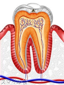 虫歯C1の模式図