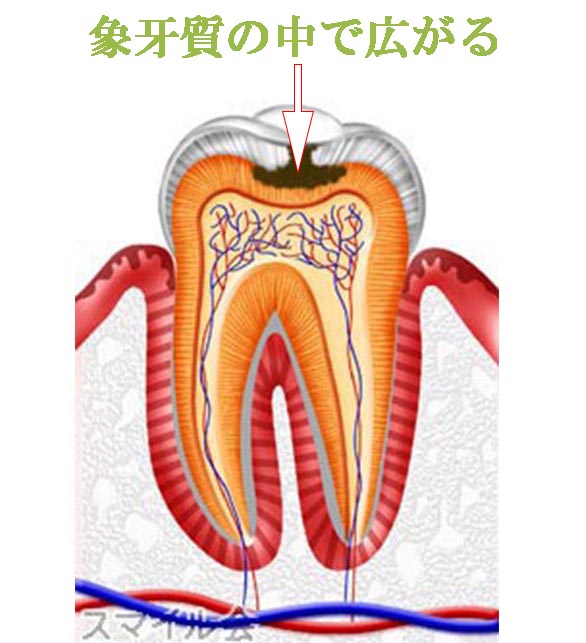 虫歯C2の特徴