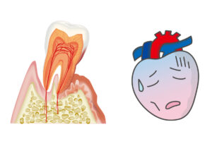 心臓病と歯周病の関係