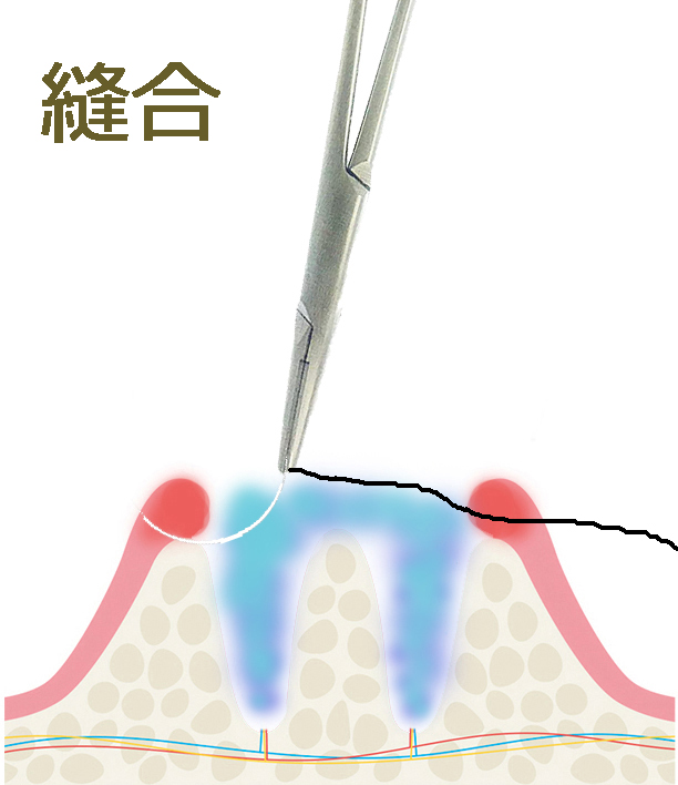 必要に応じた縫合
