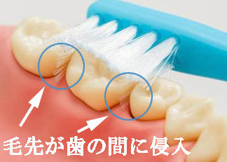 つまようじ法は歯ブラシの毛先を歯の間に差し込むようにして歯垢を除去します。