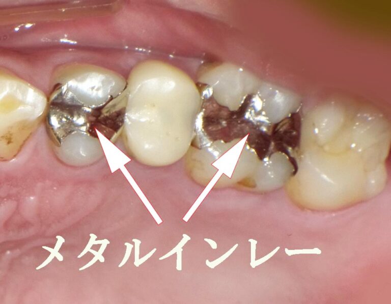 小臼歯と大臼歯の隣接面にできたC2虫歯の修復例