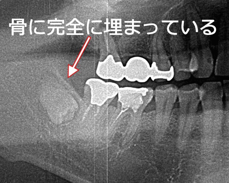 完全埋没した親知らずは必ずしも抜歯の対象ではない
