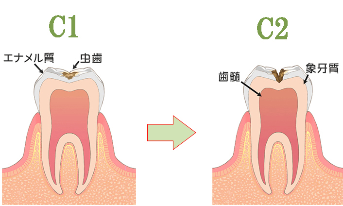 虫歯C1からC2への進行速度