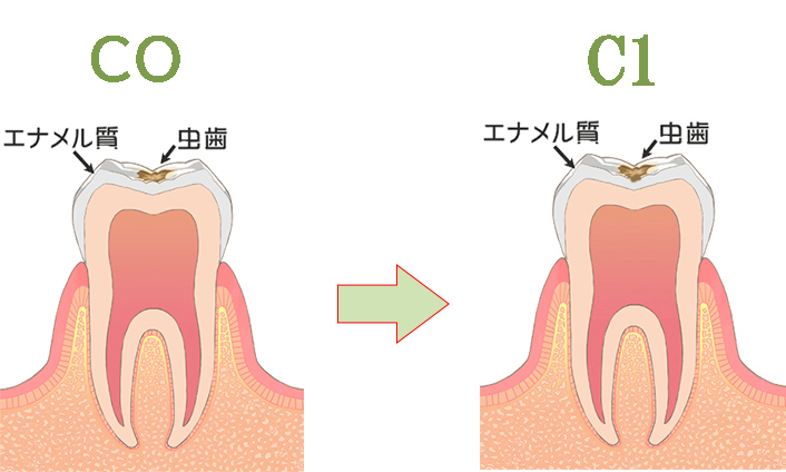 虫歯COからC1への進行速度