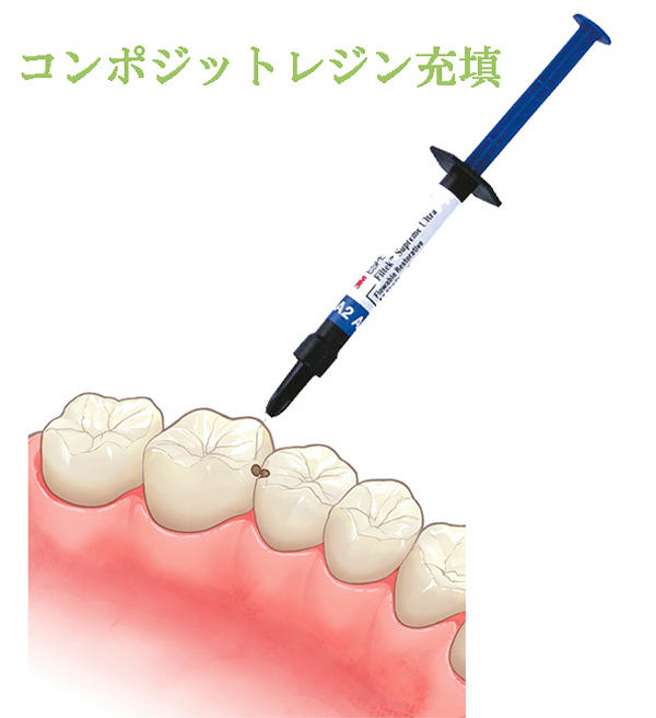 コンポジットレジン充填