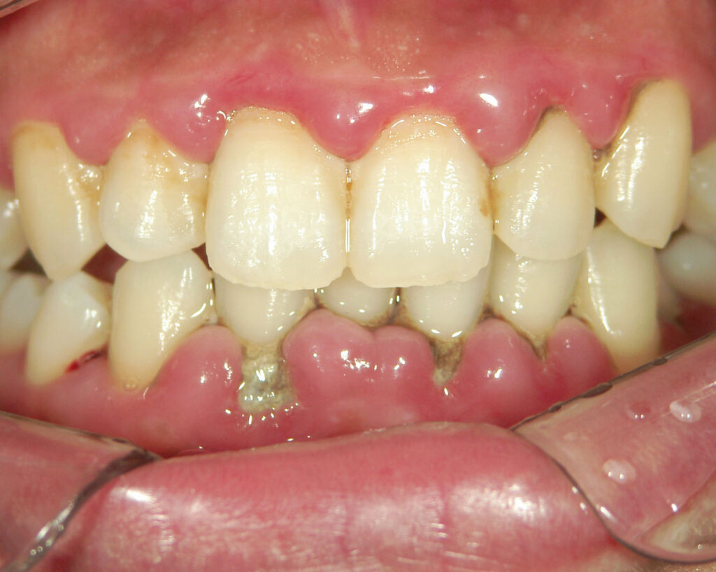 歯周病手遅れ症状　歯茎が大きく腫れ出血を伴う