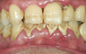 歯周病の手遅れ症状