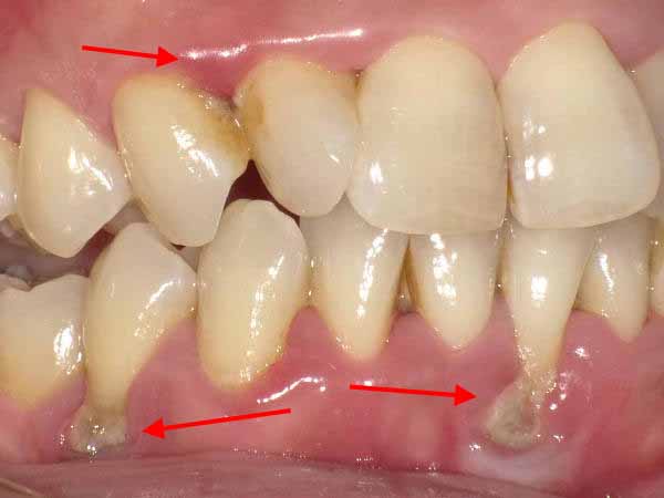 歯周病の急性発作で歯の動揺が強くなった時